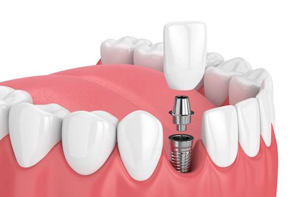 implant procedure