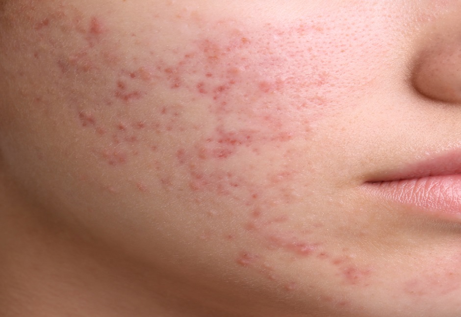 Acne-Prone Skin