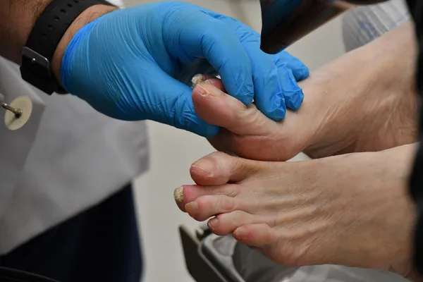 Bunion Surgery